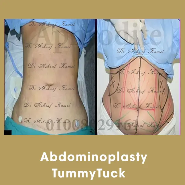 Liposuction Gynecomastia