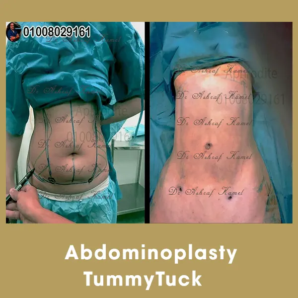 Liposuction Gynecomastia