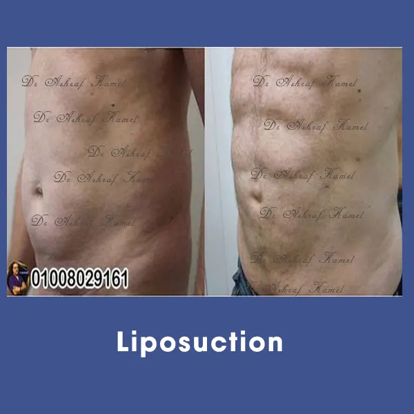 Liposuction