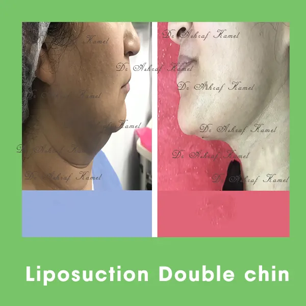 Liposuction Double Chin