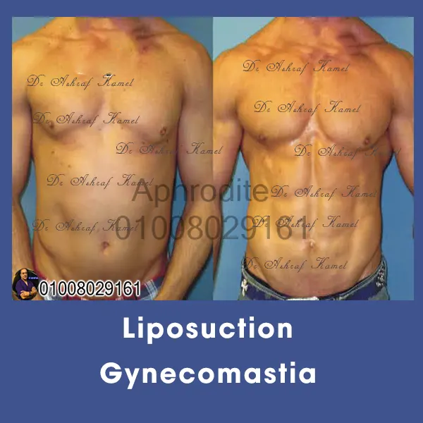 Liposuction Gynecomastia