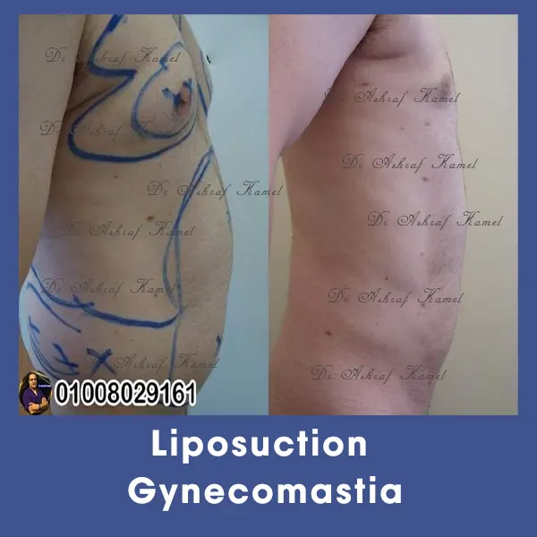 Liposuction Gynecomastia
