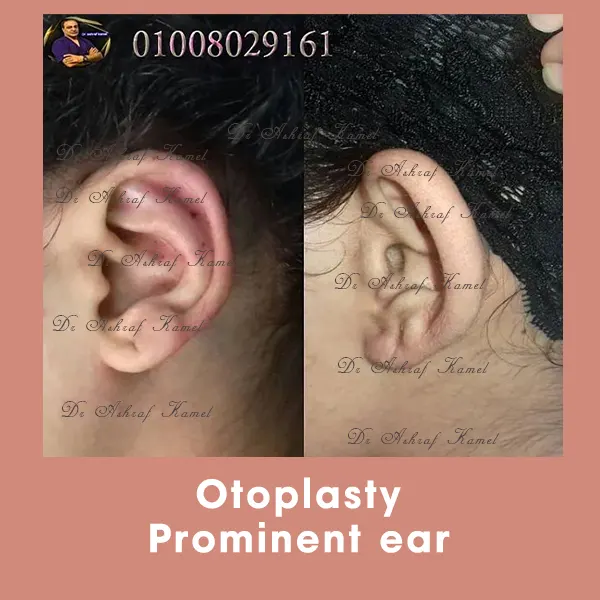 Liposuction Gynecomastia