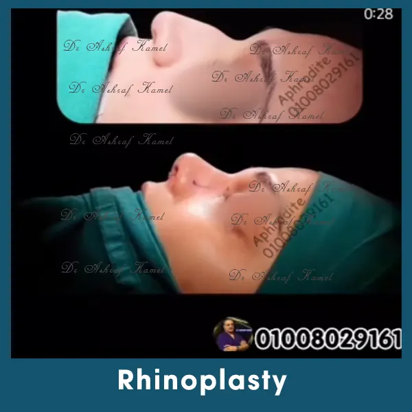 Rhinoplasty