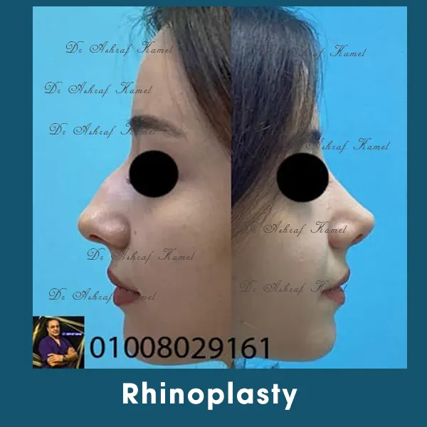 Liposuction Gynecomastia