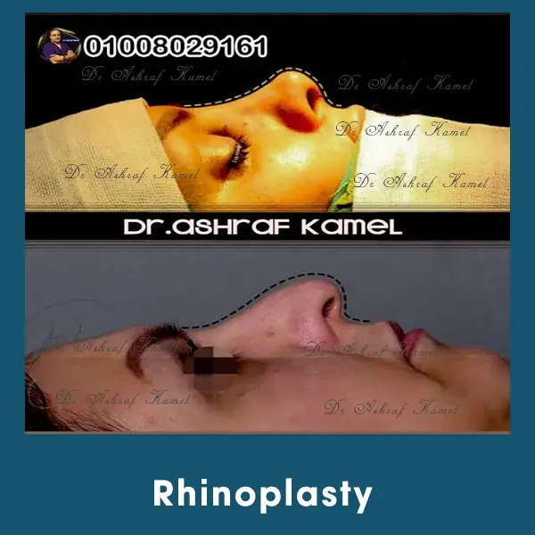 Liposuction Gynecomastia