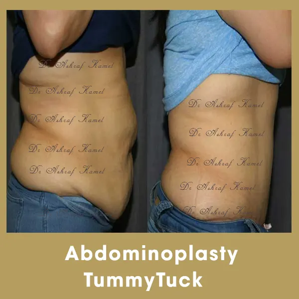 Abdominalplasty
