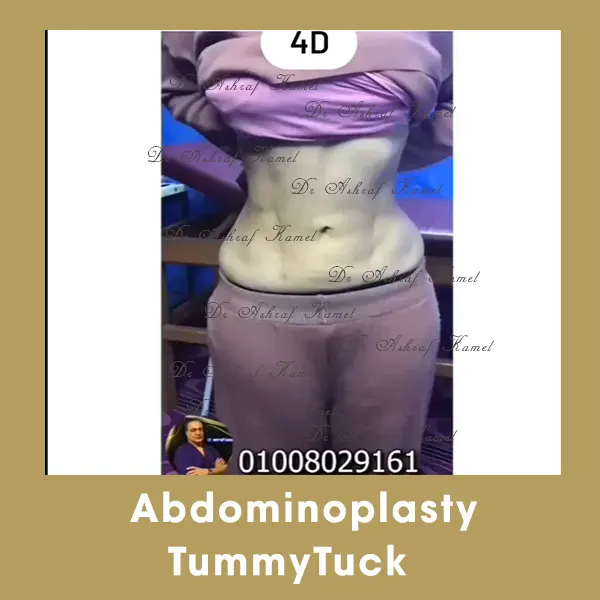 Abdominalplasty