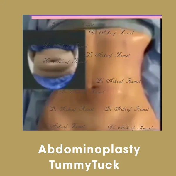 Abdominalplasty